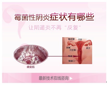 所以,女性朋友对于霉菌性阴道炎一定要做到及时发现,及时检查,及时